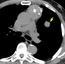 Axial images from an unenhanced chest CT at the level of the pulmonary trunk demonstrate an anterior mediastinal mass with aggressive features suggested by the coarse calcifications within it and the irregular lobulated margin with the lung, suggestive of pulmonary invasion. In addition, there is a <strong>pulmonary nodule(arrow)</strong> in the left upper lobe, confirmed by biopsy to represent a metastasis. 